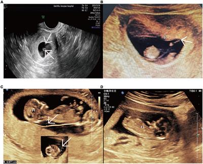 Determining the cause of intrauterine fetal death in monochorionic twins: A case report